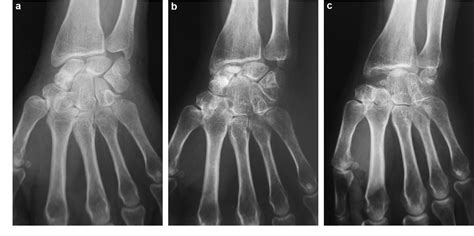 Figure 1 From Idiopathic Avascular Necrosis Of The Scaphoid 10 New