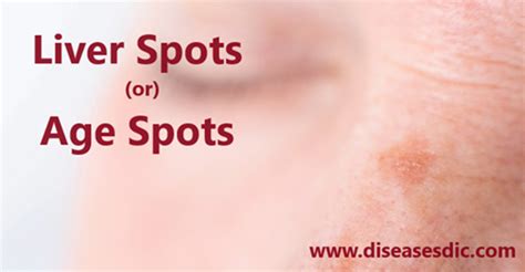 Liver Spots Age Spots Symptoms Causes And Home Remedies