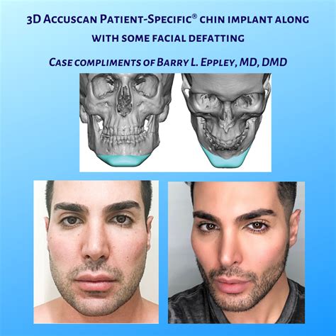 Home Implantech Facial Implant Male Plastic Surgery Chin Implant