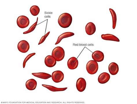 What Is Sickle Cell Anemia? - Modern Biology Inc