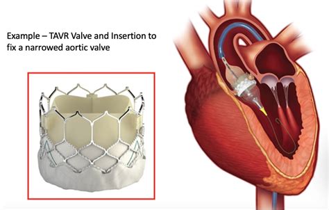 Tavr Replacing The Aortic Valve Without Open Heart Surgery Englewood