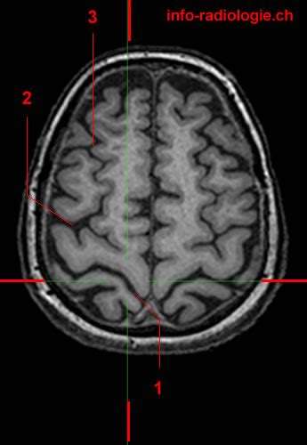 Central Sulcus Fissure Of Rolando