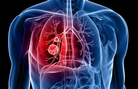 Pneumococcal Pneumonia Causes Symptoms Transmissions Diagnosis And