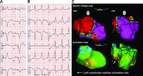 Surface 12 Lead Electrocardiograms A At Baseline B During