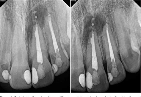 Figure From Three Year Follow Up Healing Of A Large Periapical