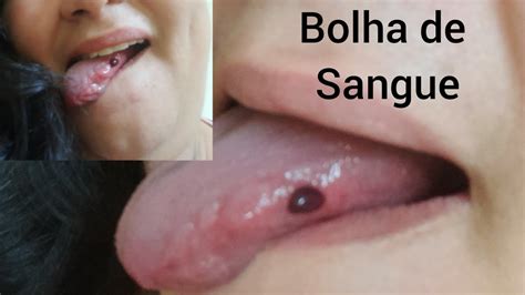 bolhas de sangue na lingua não sei oque fazer YouTube