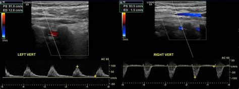 Subclavian Steal Syndrome: Symptoms, Diagnosis and Treatment