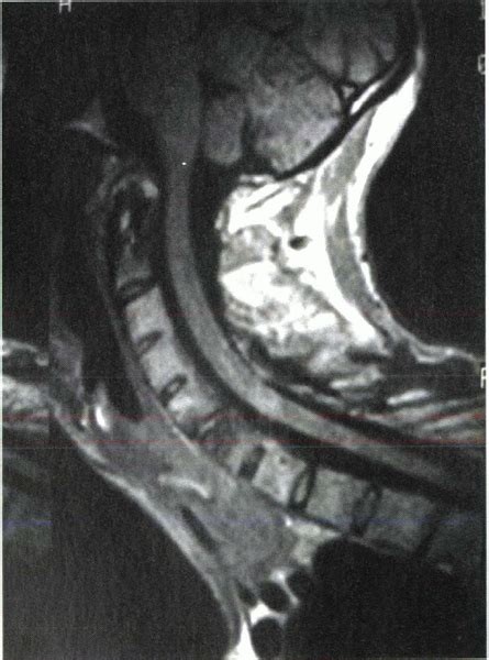 Ankylosing Spondylitis Teachme Orthopedics