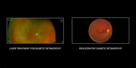 Diabetic Retinopathy Symptoms Causes And Treatment