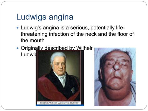 Ludwigs Angina Ppt