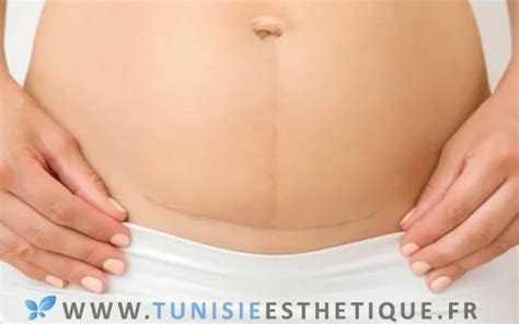 Abdominoplastie Tunisie Tout Ce Que Vous Devez Savoir