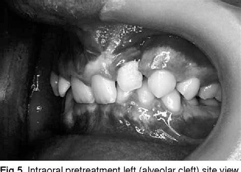 Figure From Reconstruction Of An Alveolar Cleft For Orthodontic