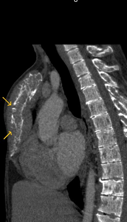 Extramedullary Hematopoiesis Pacs