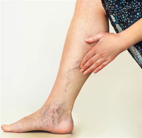 Spider Veins Laser Therapy Dubai - Varicose Veins Treatment Dubai - New Al Shefa