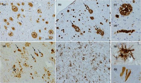 Fig Pathology Of Alzheimer S Disease A Immunohistochemistry