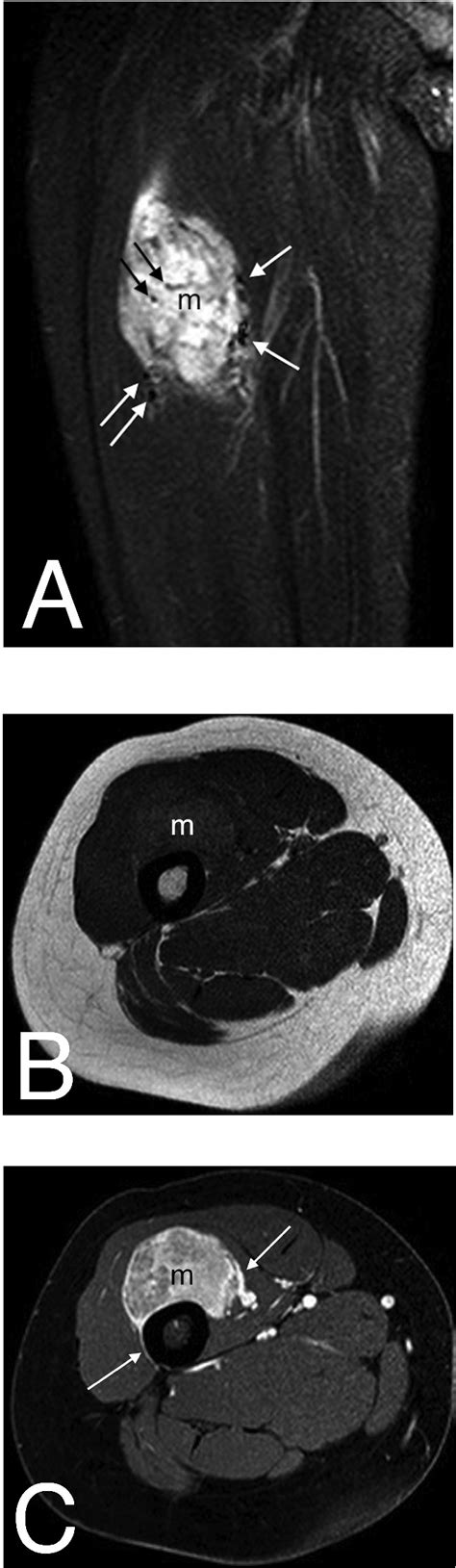 Coronal T2-weighted short tau inversion recovery magnetic resonance ... 