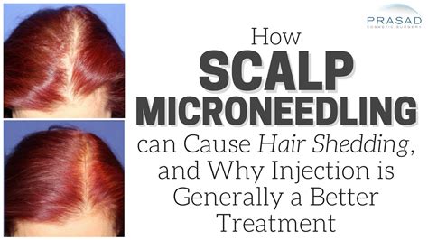 Micro Needling For Hair Loss Spefashion