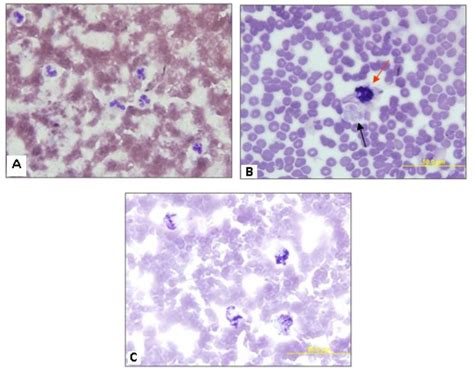 Neutrophil Functional Assay Nitroblue Tetrazolium Nbt Slide Tests