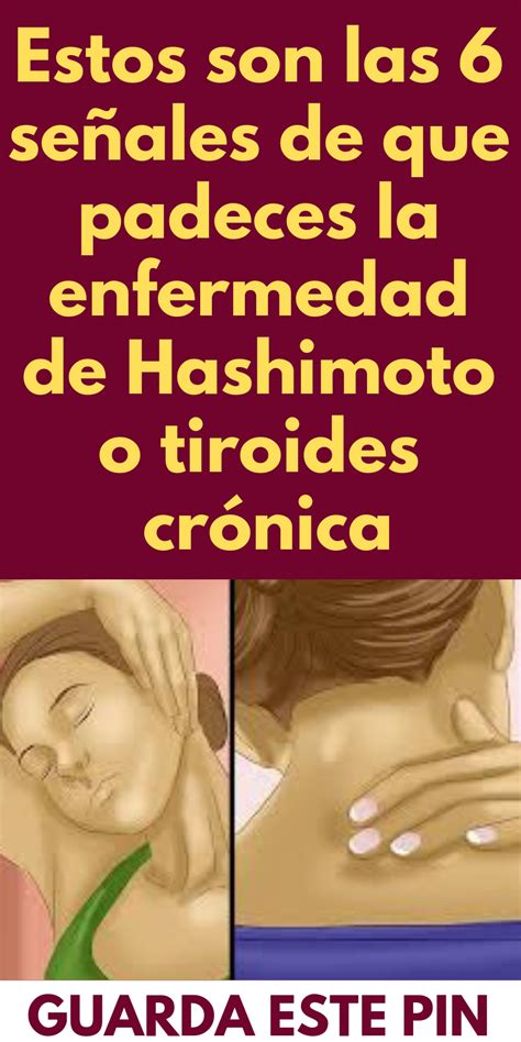 Estos Son Las 6 Señales De Que Padeces La Enfermedad De Hashimoto O