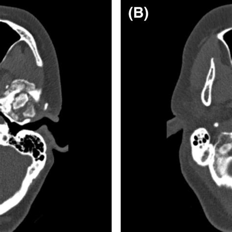 Preoperative photograph showing diffuse preauricular swelling on the ...