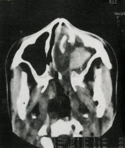 Sinus Aspergillosis And Allergic Fungal Sinusitis Annals Of Saudi