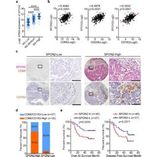 Spon Is Positively Correlated With M Tam Infiltration And Poor