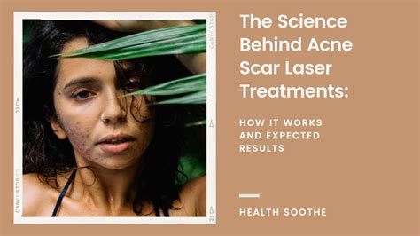 The Science Behind Acne Scar Laser Treatments How It Works And