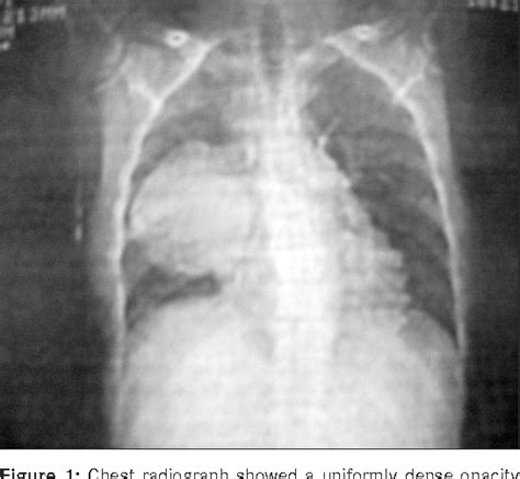 Figure From Mediastinal Bronchogenic Cyst With Back Pain Semantic