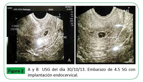 Embarazo Cervical Reporte De Caso Revision Bibliografica