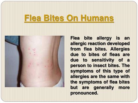 PPT - Flea Bites On Humans PowerPoint Presentation - ID:1496761