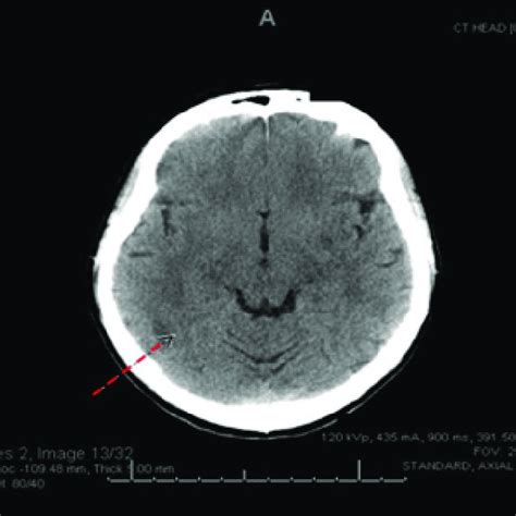 Computed Tomography Ct Scan Of The Head Showing Vague Hypodensity In