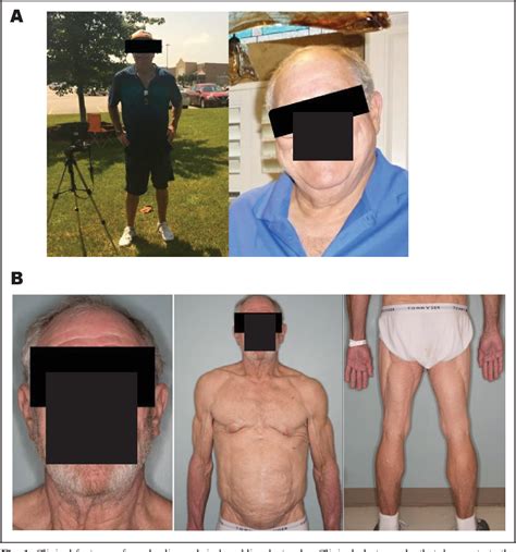 Figure 1 From A Case Of Acquired Generalized Lipodystrophy Associated