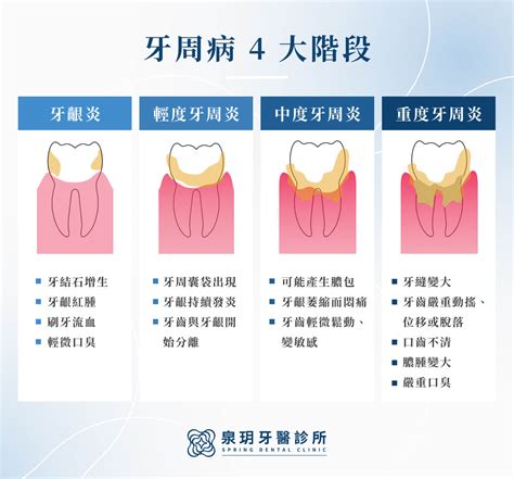 牙周病是什麼？會自己好嗎？剖析常見9大症狀、改善方法！ 泉玥牙醫診所 台北植牙 全口重建 牙齒美容