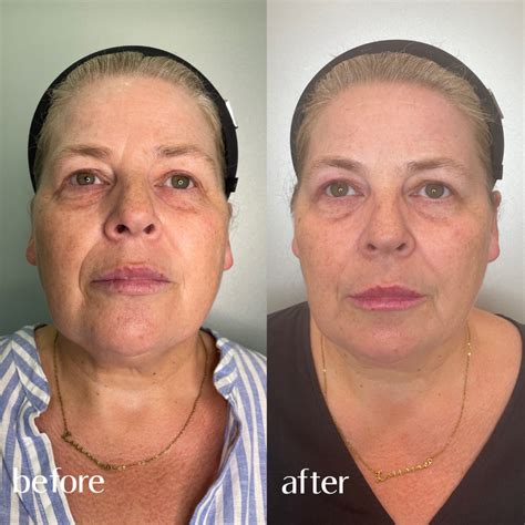 Ameela Facial Rejuvenation Strong 25 Eden Medical Clinic