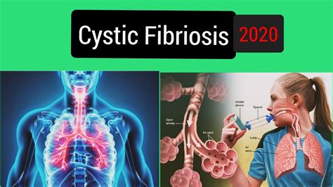 CYSTIC FIBROSIS Signs And Symptoms Causes Diagnosis And Treatment