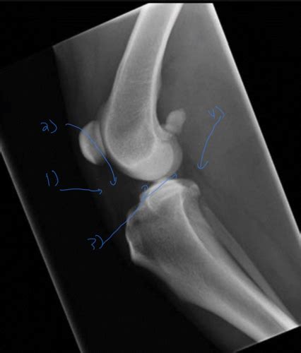 Radiology Of The Joints Flashcards Quizlet