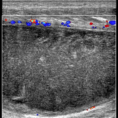 Hematoma Seroma Radiology Key