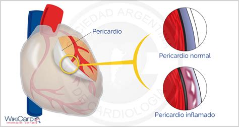 Pericarditis WikiCardio