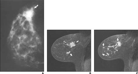 Figure 2 From Mr Imaging Of The Ipsilateral Breast In Women With Percutaneously Proven Breast