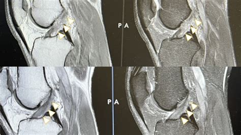 Acl Tears Articles Treatments And Insights On Regenexx