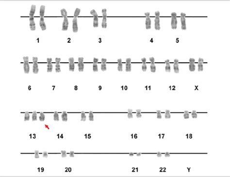 P Tau Syndrom Trisomie Klinik Genetik Lecturio