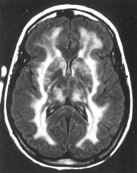 MRI Of Five Patients With Mitochondrial Neurogastrointestinal