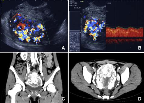 Figure 1 From A Case Of Severe Uterine Arteriovenous Malformation