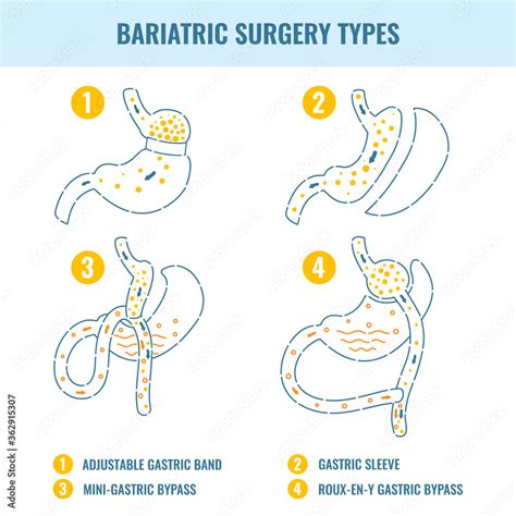 Types Of Bariatric Surgery Weight Loss Procedures Gastric Bypass