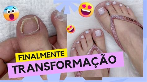 Transformação Completa Das Unhas Dos PÉs Depois De 4 Meses Youtube