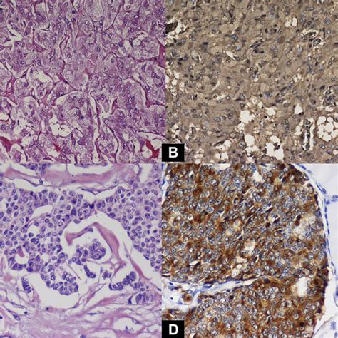 A Pathological Analysis Of The Adrenal Gland Tumor Showed A