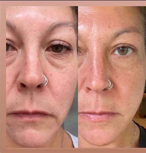 Before And After The Best Collagen Elixir