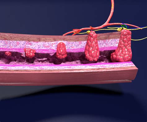 ArtStation - Colon Cancer staging labelled | Resources