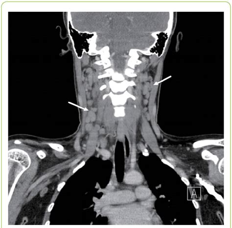 Can An Mri Without Contrast Show Swollen Lymph Nodes In The Groin Or