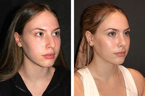 Rhinoplasty Nose Job Best Rhinoplasty Results New York